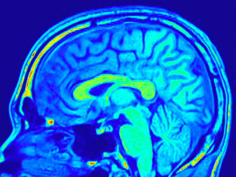 An MRI scan of a human brain.